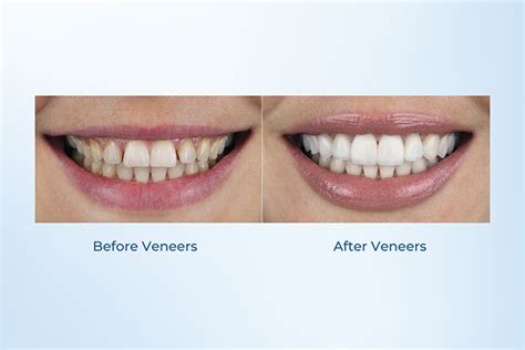 resin veneers|Veneers Teeth Pros and Cons: Are They Good for .